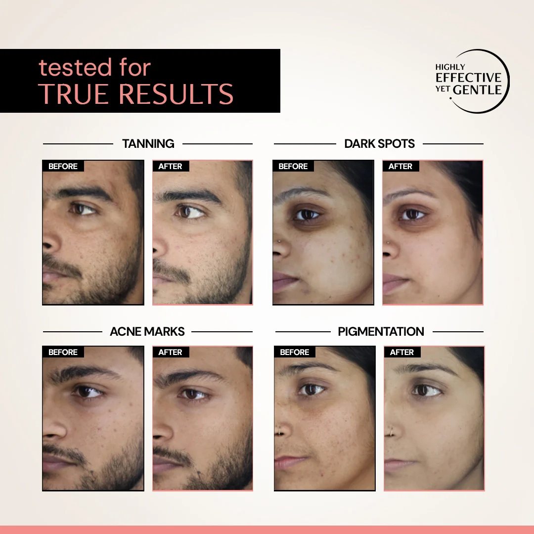 Clearing Serum with 5% Niacinamide & 2% Alpha Arbutin| 4-in-1 Multi-Benefit | Clinically Tested - Image 5