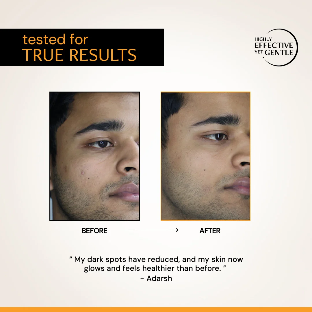 10% Vitamin C Serum for Glowing Skin | Clinically Tested, Non-Irritating| Brightens & Evens Tone | For Oily Skin - Image 5